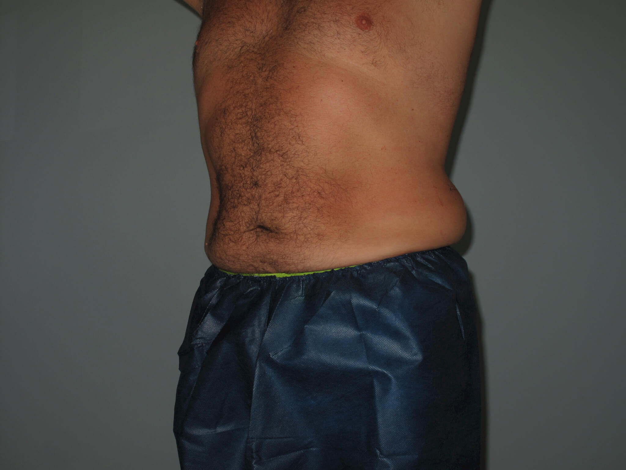 Liposuction Before and After Photos Laser Lipo & Vein Center