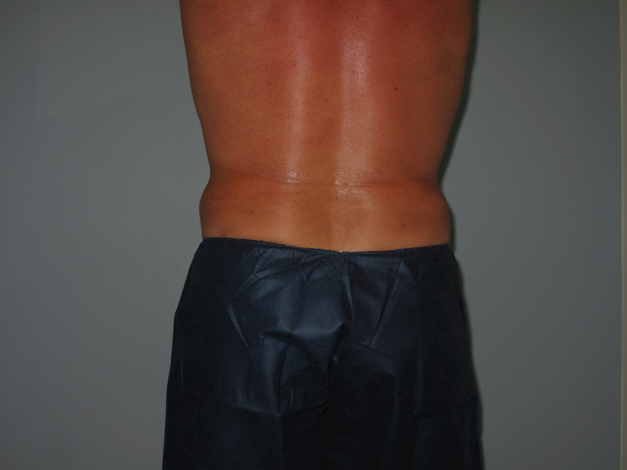 Liposuction Before and After Photos Laser Lipo & Vein Center