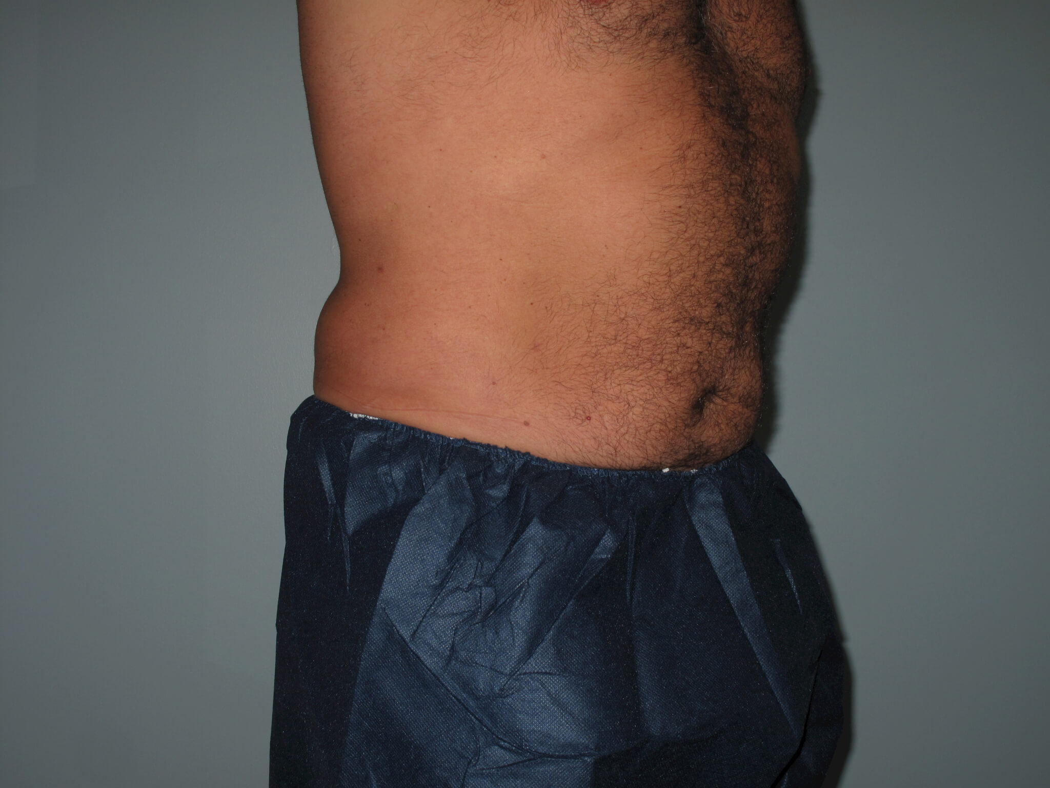 Liposuction Before and After Photos Laser Lipo & Vein Center