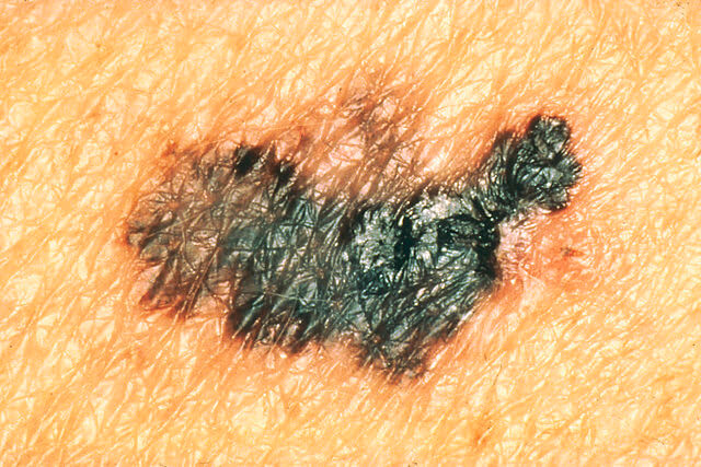 Melanoma Differences - Learn from your St Louis Dermatologist Melanoma Differences - Learn from your St Louis Dermatologist