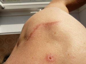Is exercise the best option for healing scar tissue