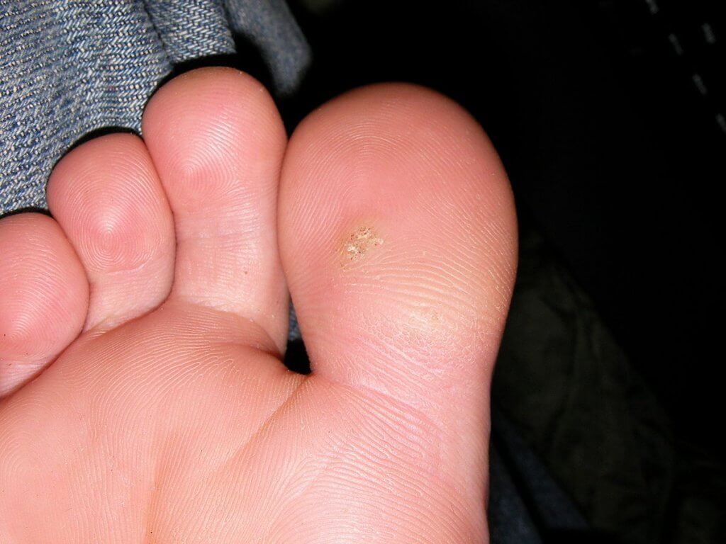 When Removing A Wart Is A Good Idea Wart Removal Surgery Laser Lipo Veins