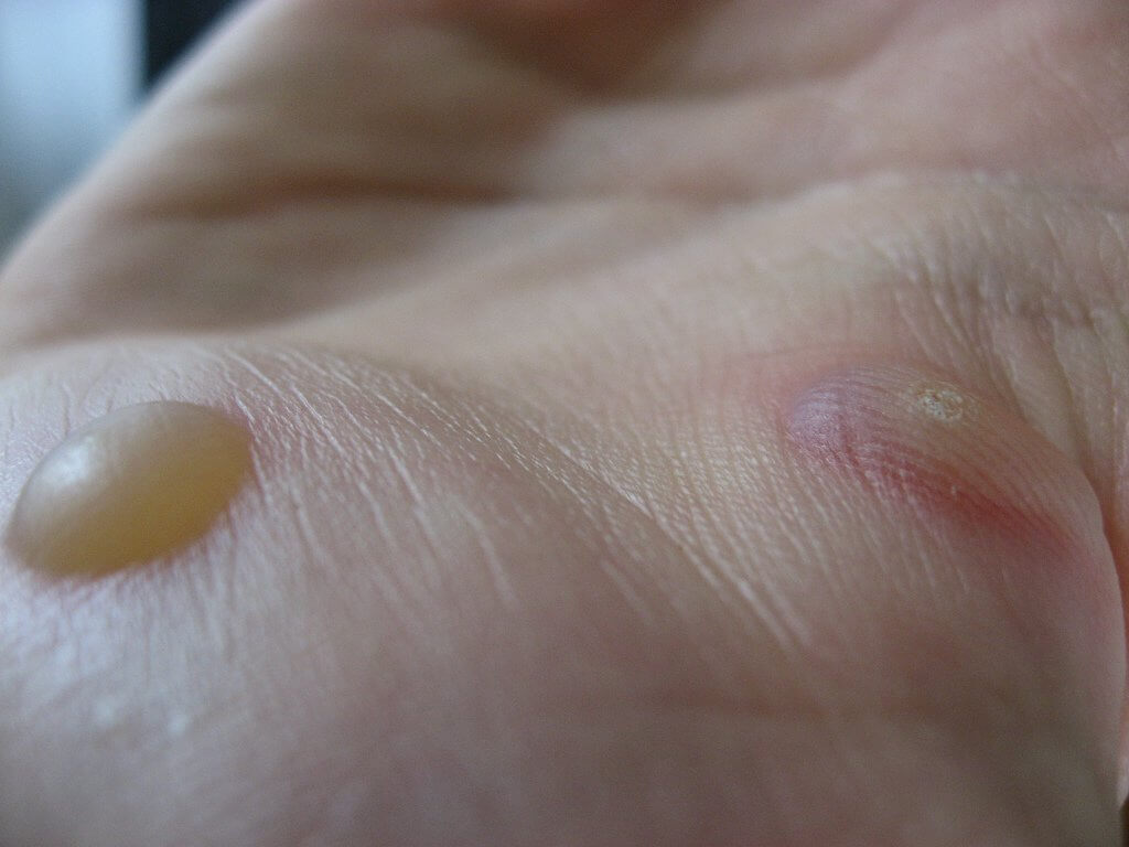 Wart Removal Side Effects from Common Procedures Laser