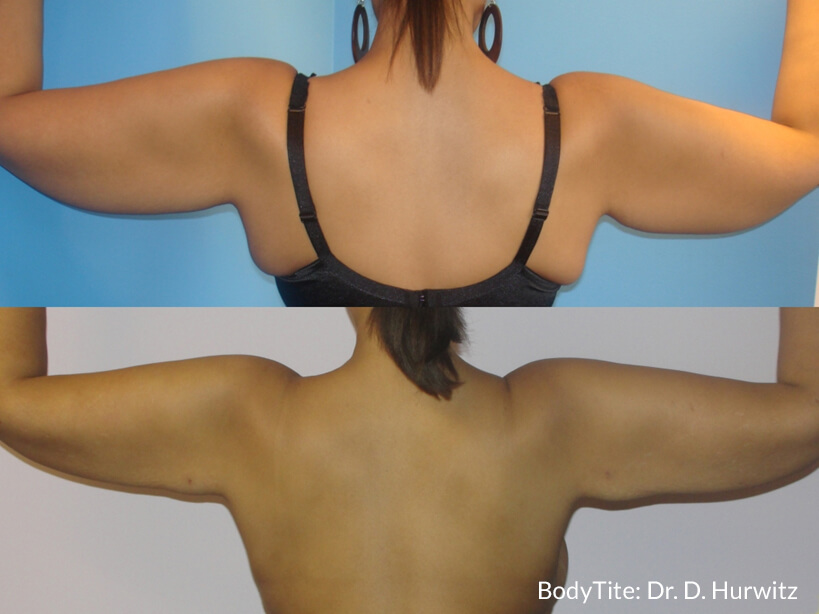 bodytite_dh_arms