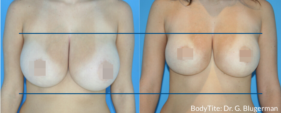 BodyTite_GB_DS_Breast1