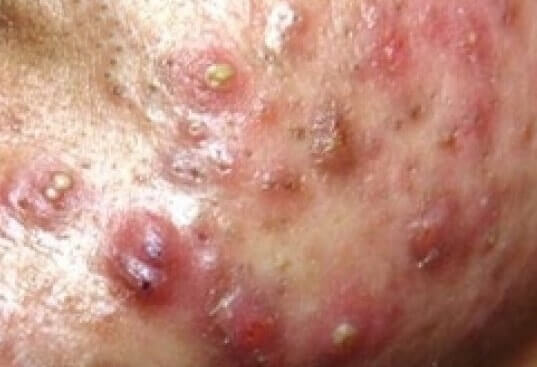 Acne popping severe Causes of