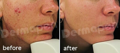 St Louis Acne Treatment Before and After