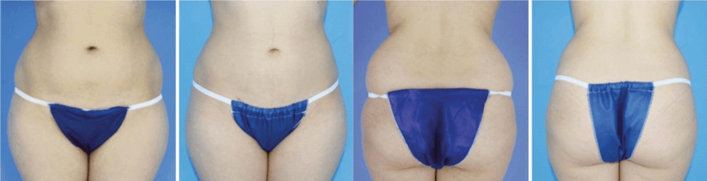 before-and-after-RFAL-986x1024