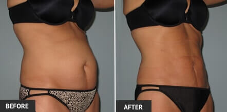 Laser Liposuction Long Island Ny Laser Liposuction Long Island Ny