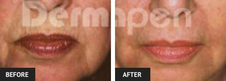 Before and After Dermapen Treatment in St Louis