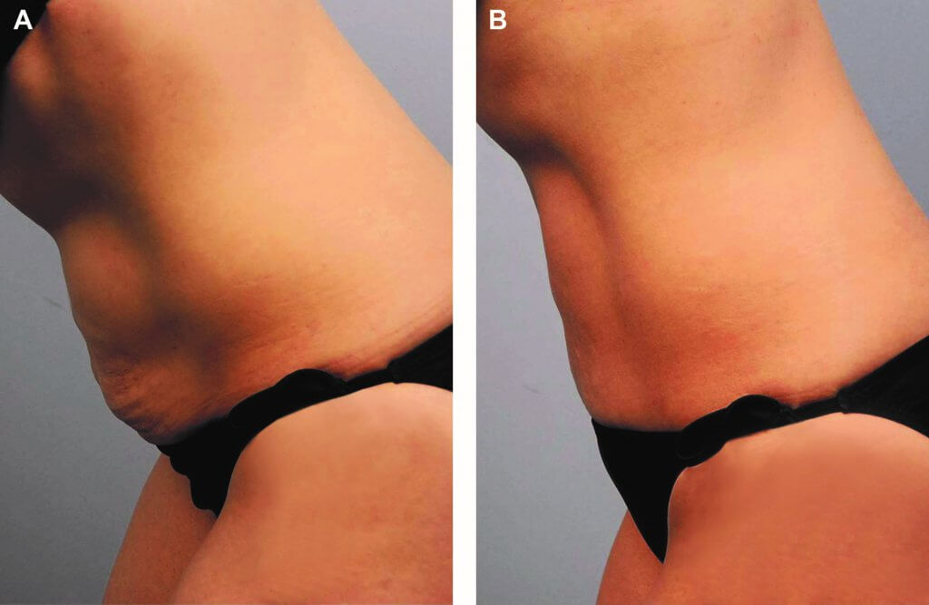 skin tightening after RFAL