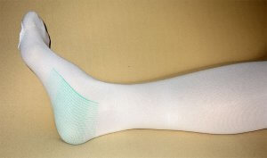 Compression Stockings for Lipedema