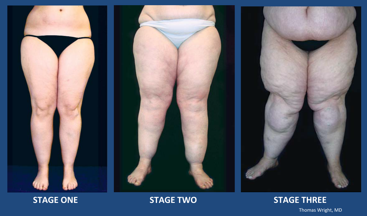 Check Out Our Lipedema Seminar, Lipedema Signs and Symptoms