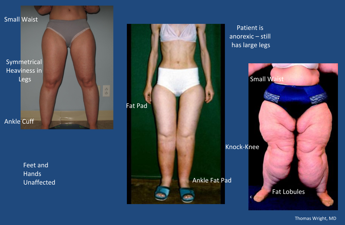 Lipedema leg online exercises