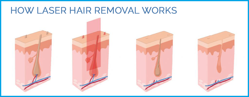 How Laser Hair Removal Works Laser Hair Removal St Louis Llav