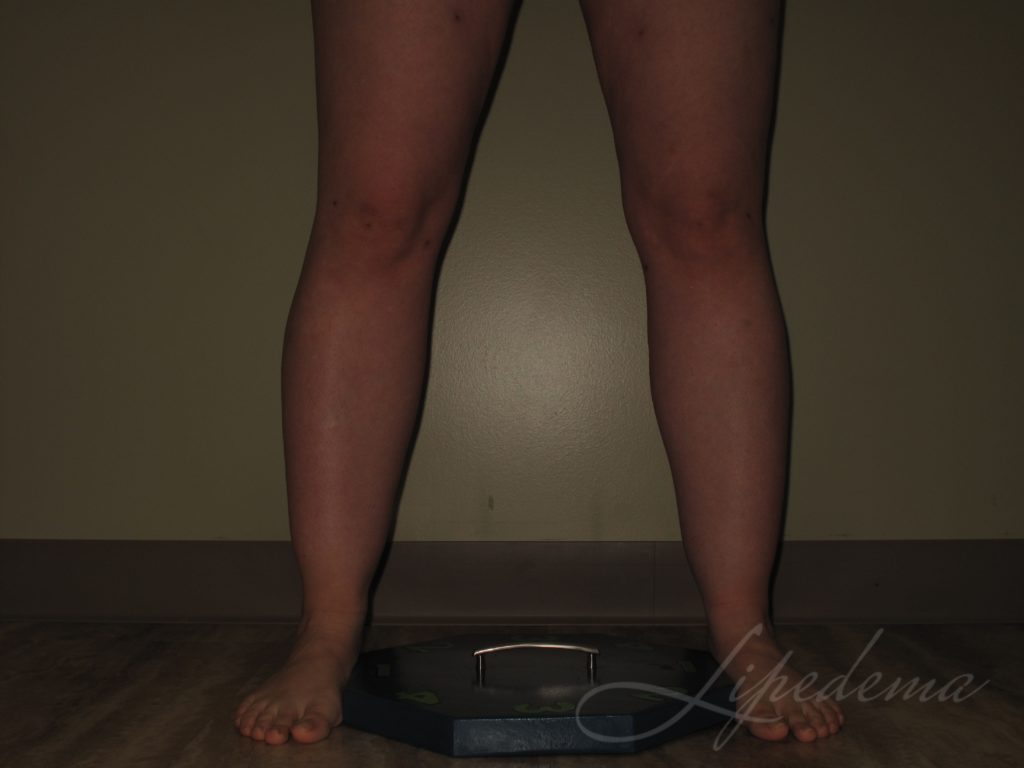 Lipedema Treatment Before and After Photos Laser Lipo and Veins
