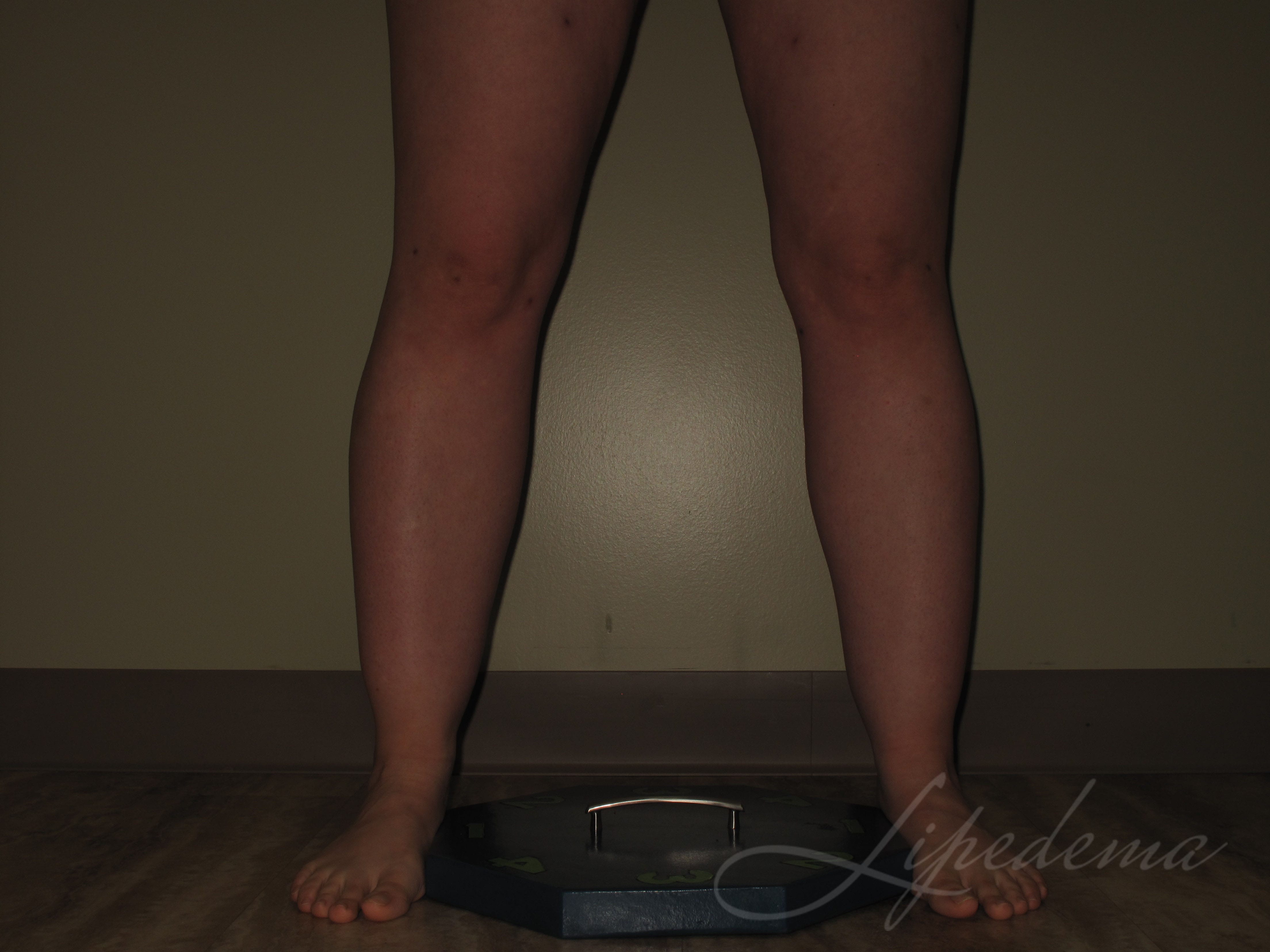 Lipedema Before and Afters Laser Lipo