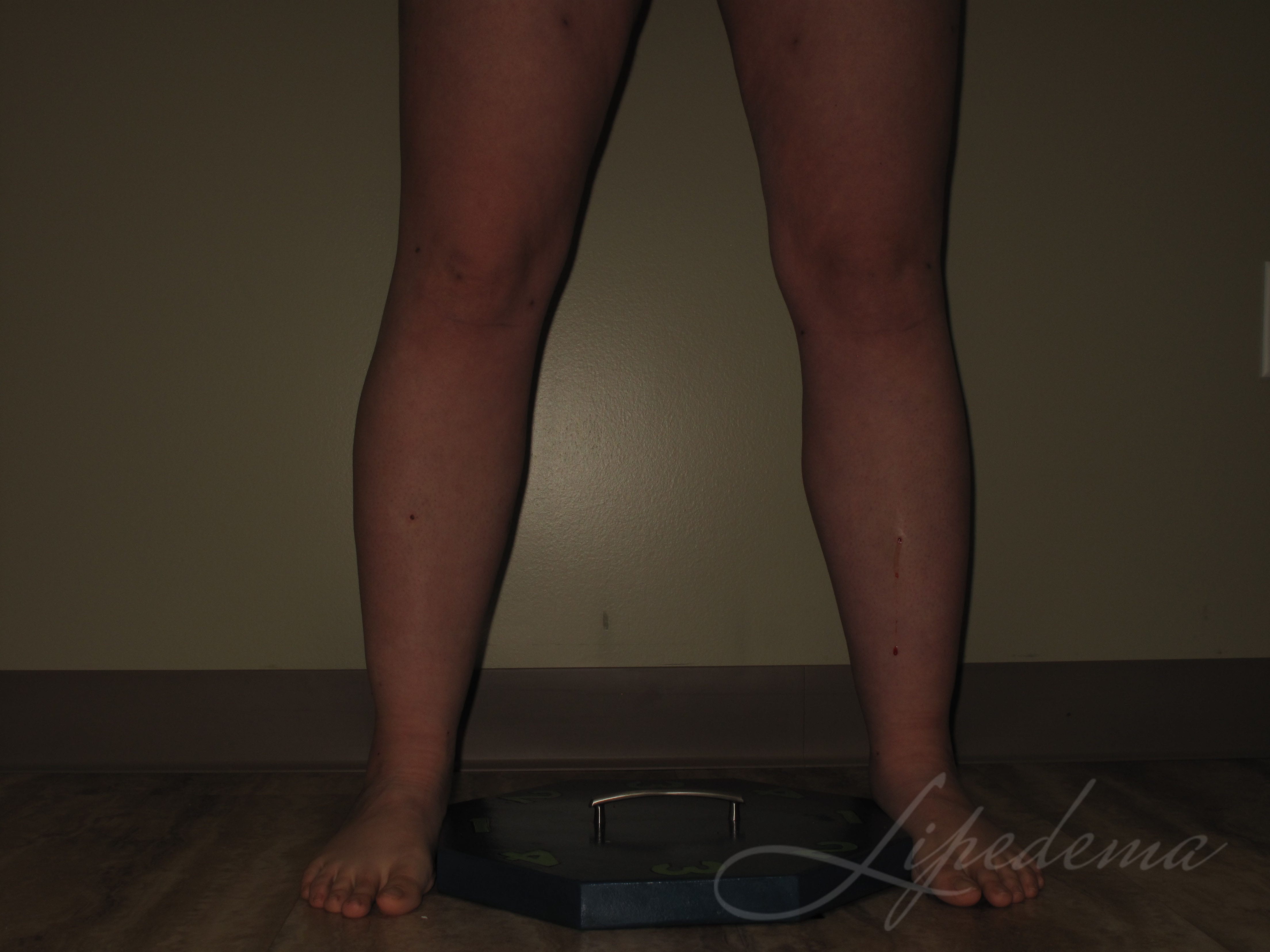 Lipedema Treatment Before and After Photos Laser Lipo and Veins Lipedema Treatment Before and After Photos Laser Lipo and Veins