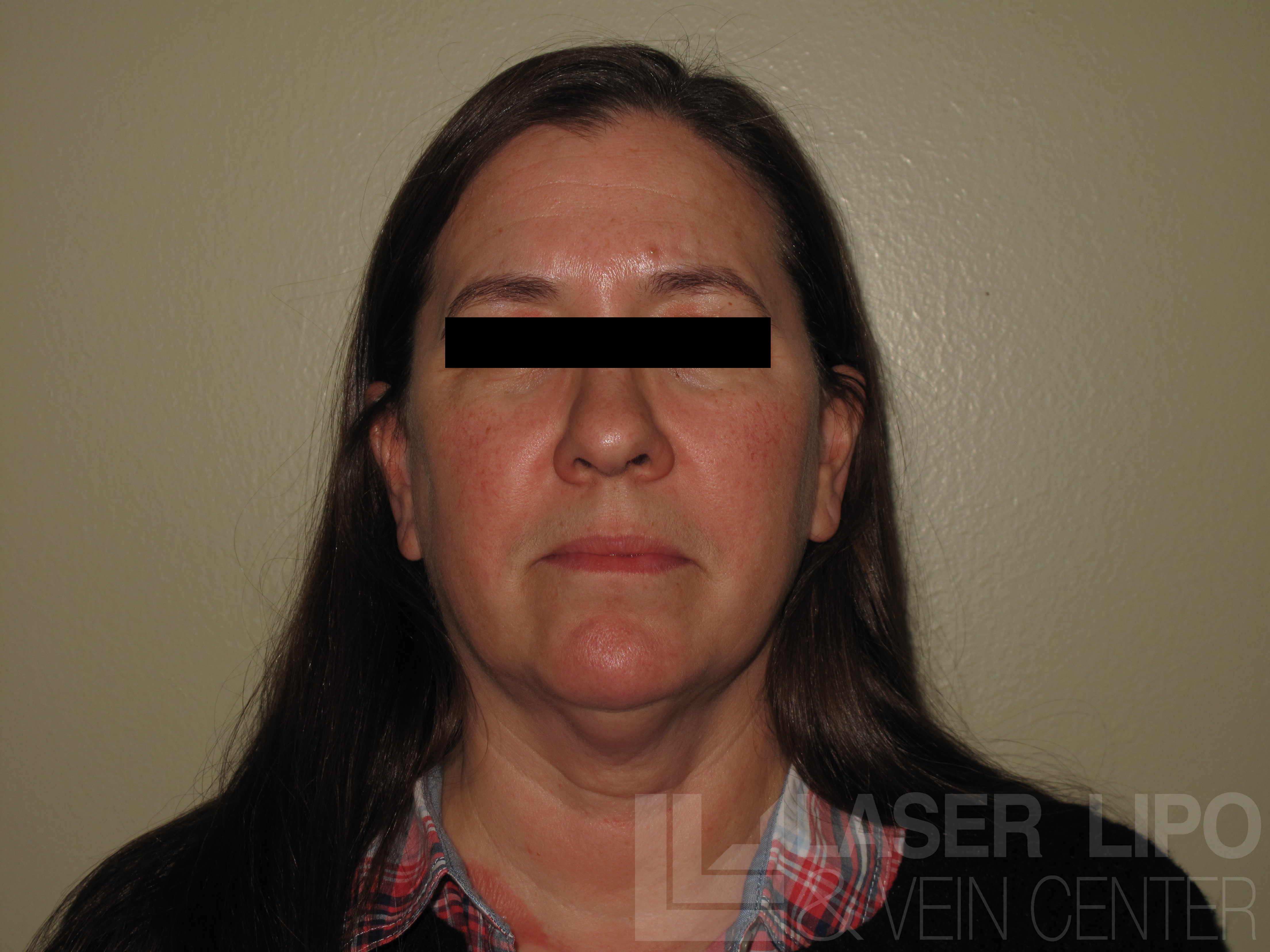 See Fat Transfer Before and After Picture Laser Lipo and Veins