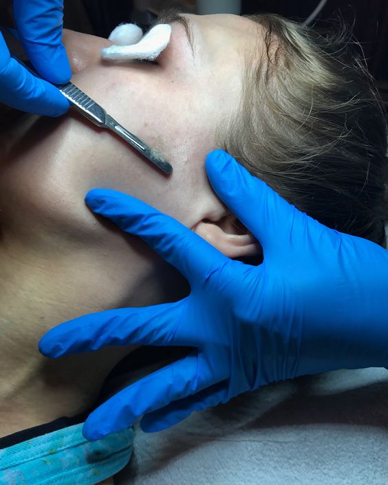 Learn About Dermaplaning in St Louis Laser Lipo and Veins