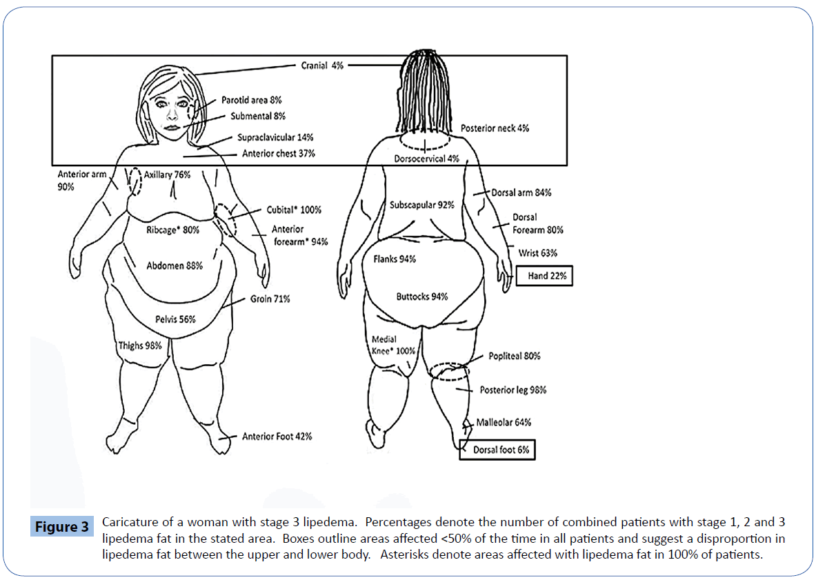 drawing of a lipedema patient