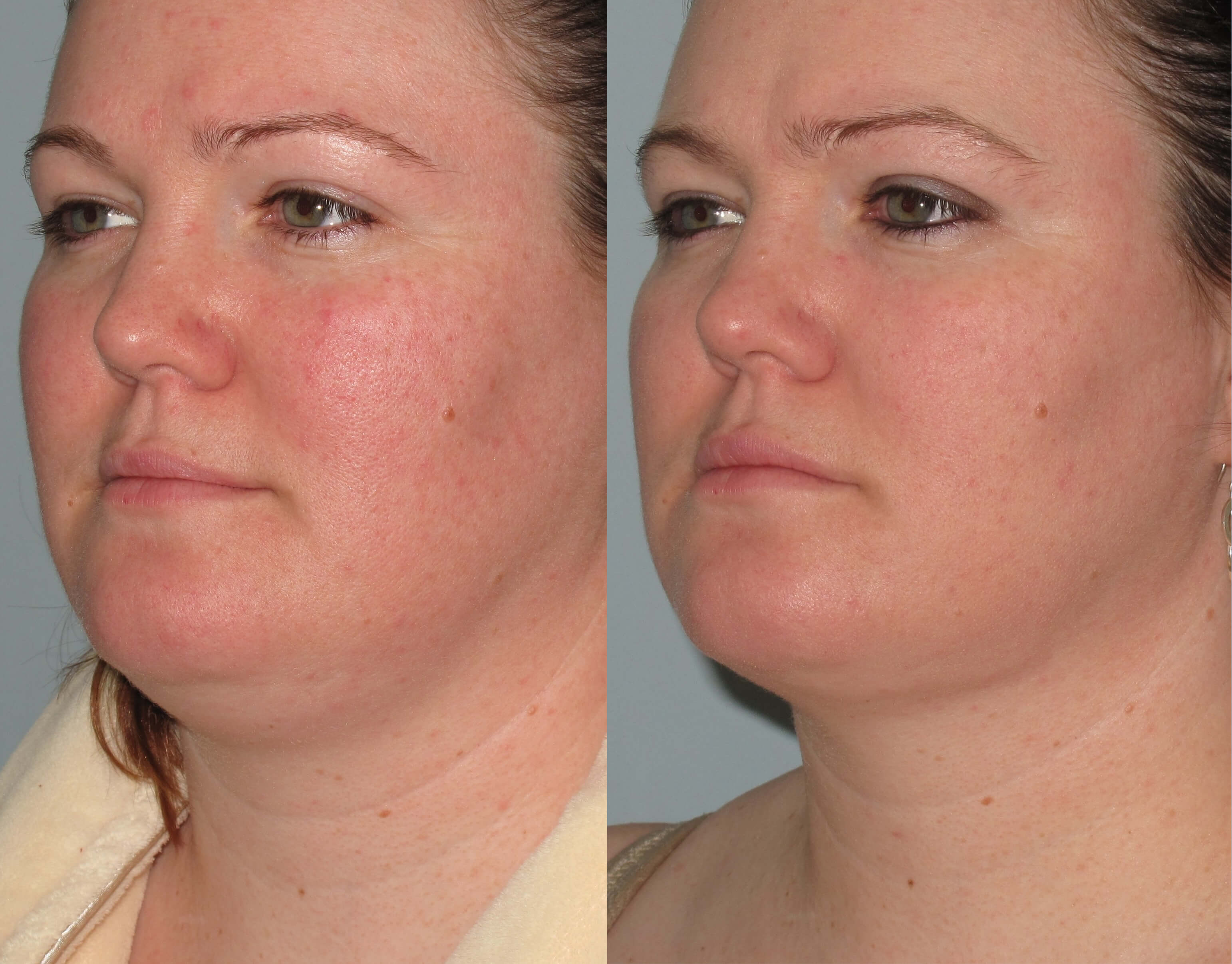 Double Chin Liposuction Price How do you Price a Switches?