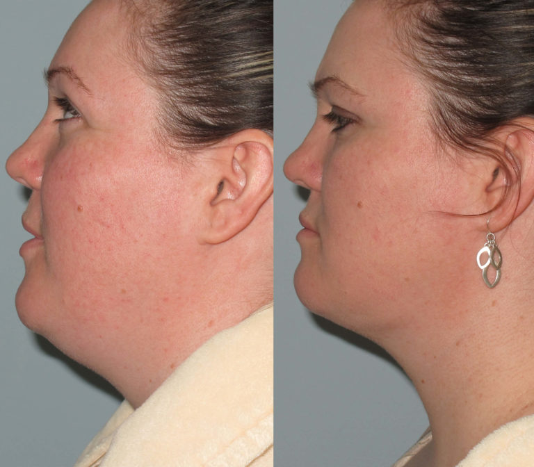 Double Chin Radio Frequency Liposuction Double Chin Liposuction By LLV double-chin-radio-frequency-liposuction-double-chin-liposuction-by-llv