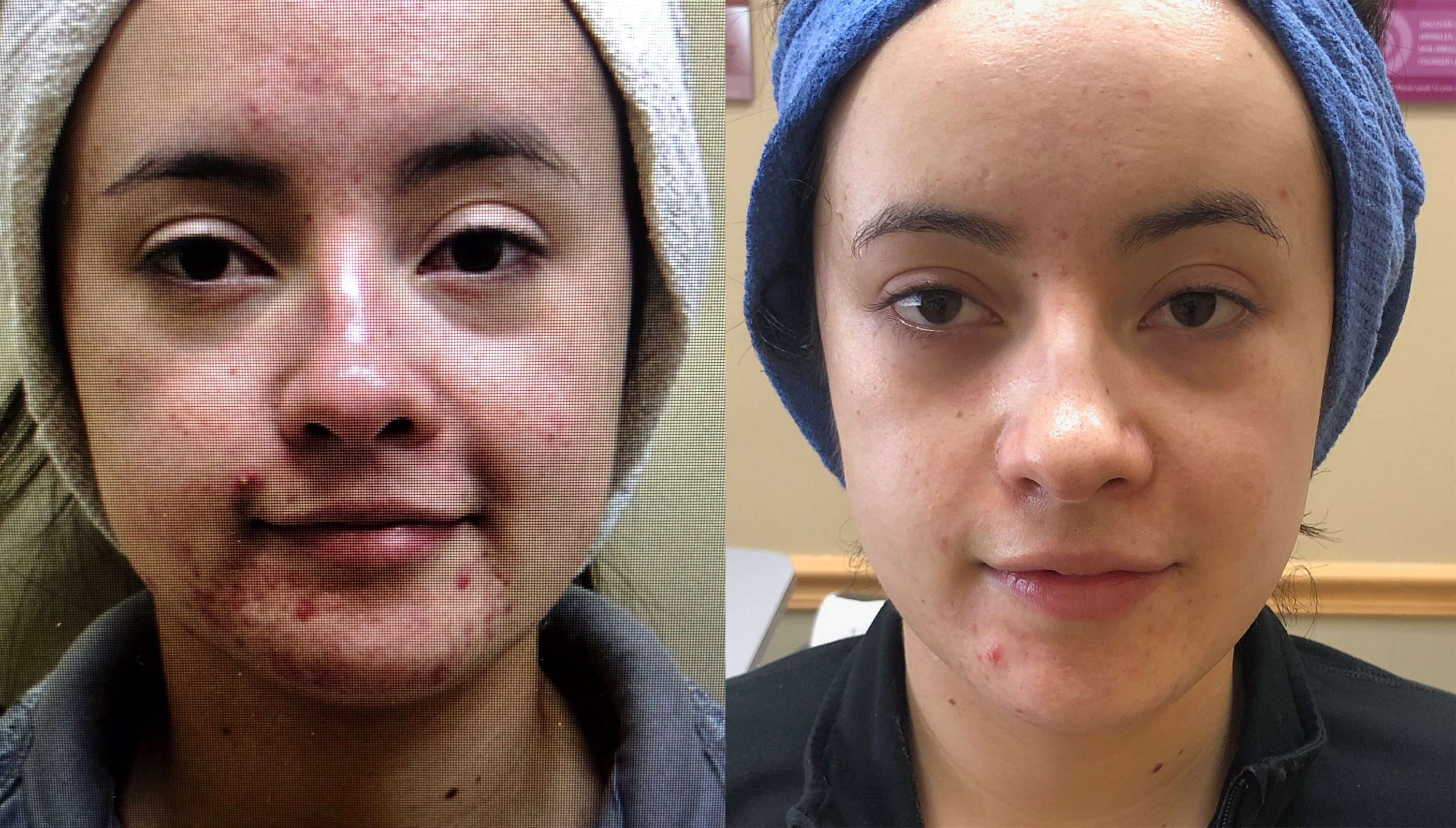 acne treatment personalized