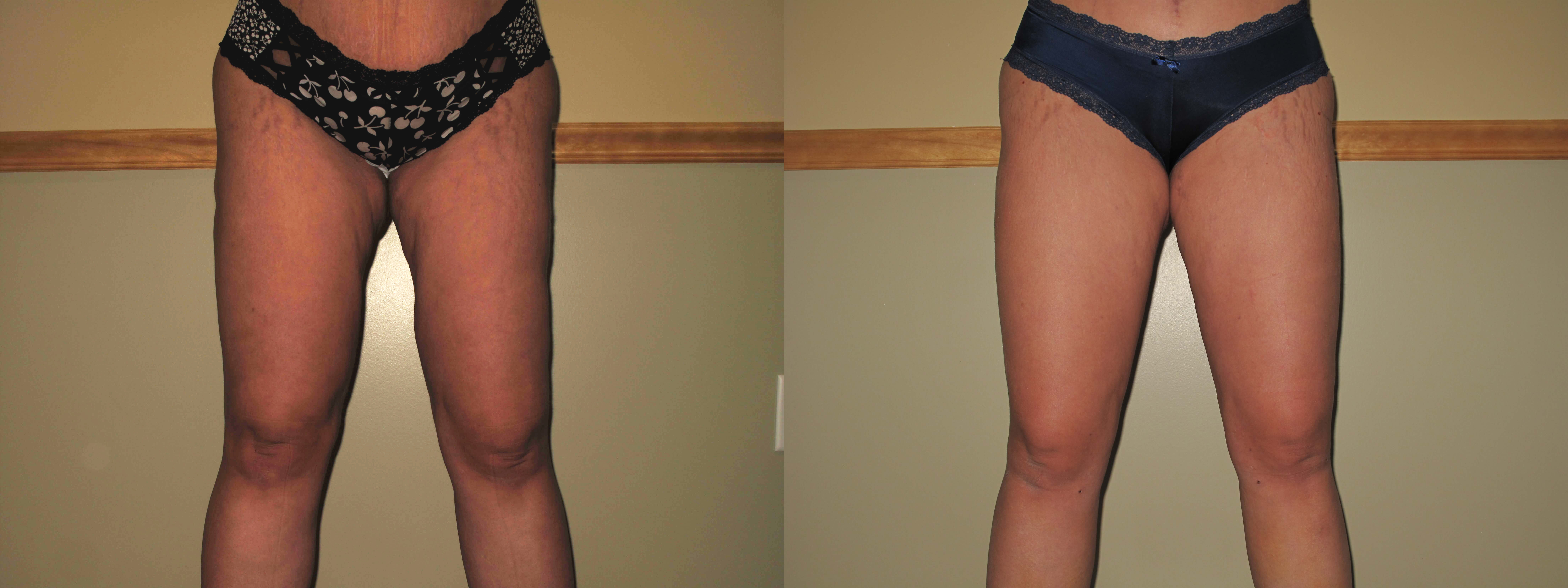 Revision Liposuction Fix Botched Or Bad Liposuction Laser Lipo Veins