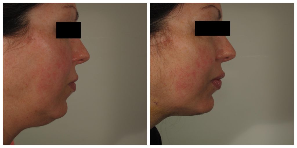 Radio Frequency Skin Tightening & Liposuction of the Neck Liposuction