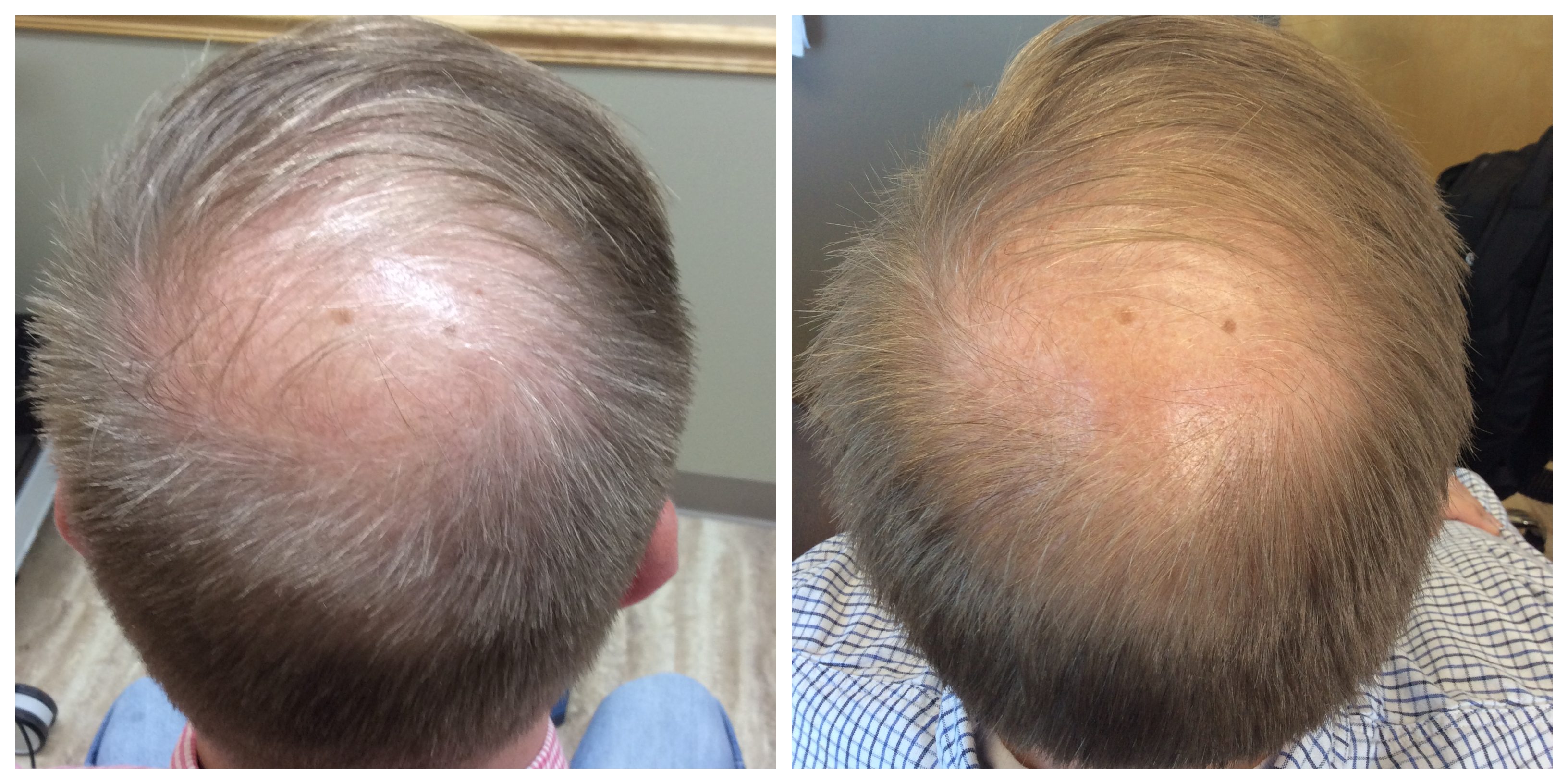 10+ Plasma Treatment For Hair Loss Pictures