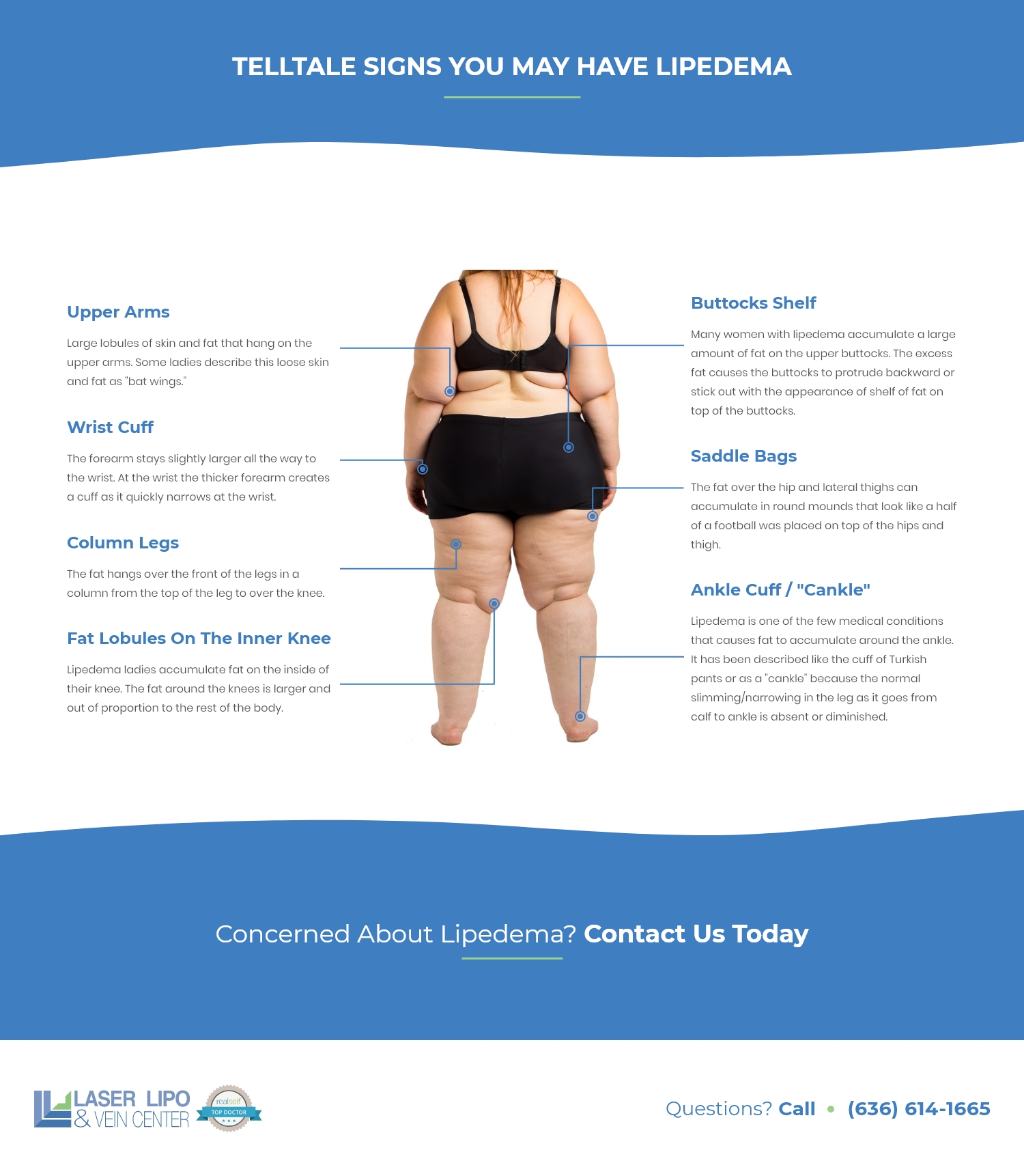 Where Does Lipedema Fat Accumulate Laser Lipo and Vein Center