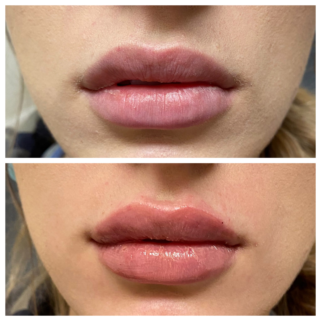 types of lip fillers