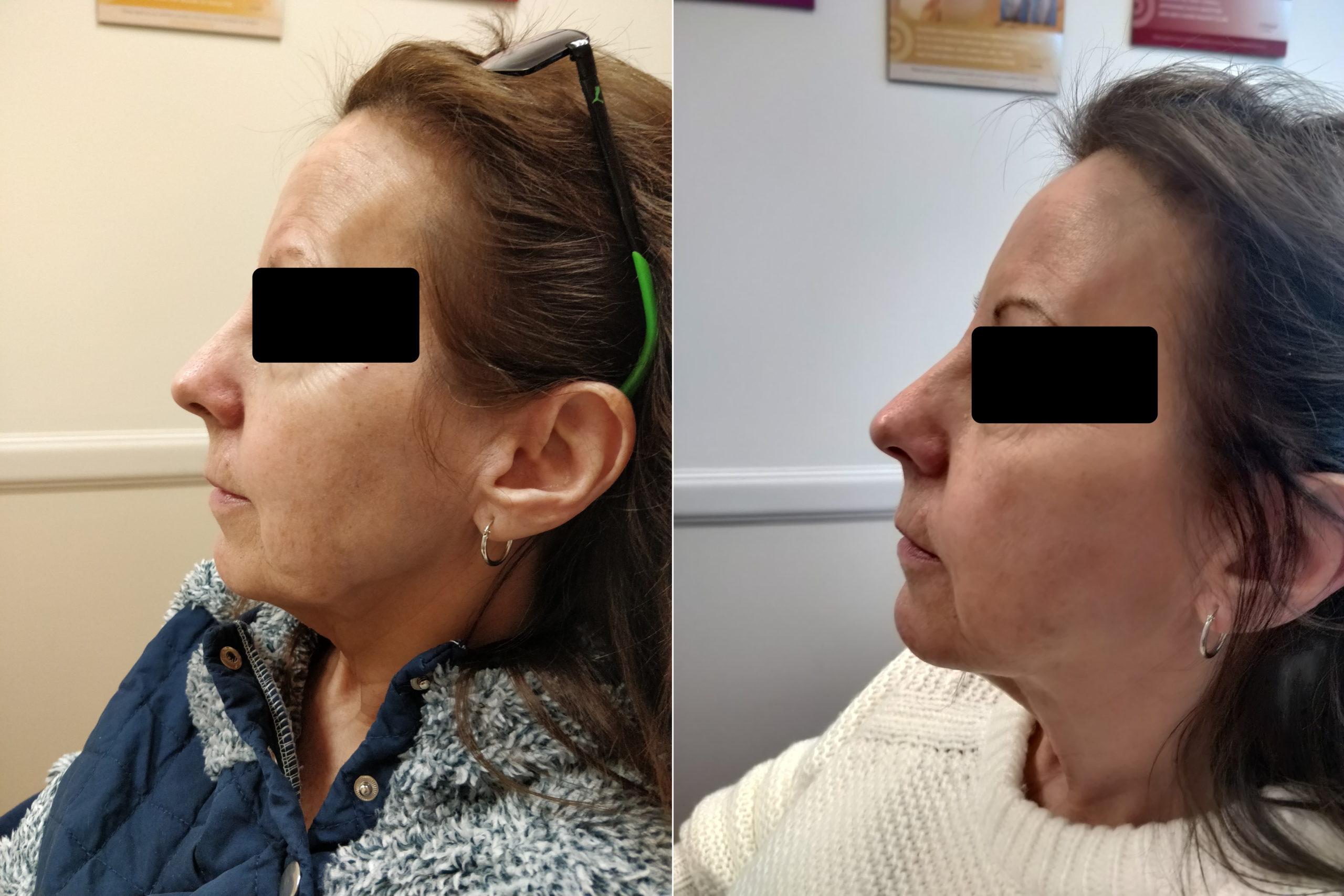 St Louis Cosmetic Injectables and Dermal Fillers Laser Lipo and Vein