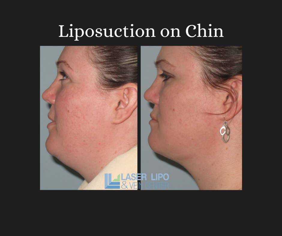 Lipo + Renuvion A Match Made in Heaven Laser Lipo