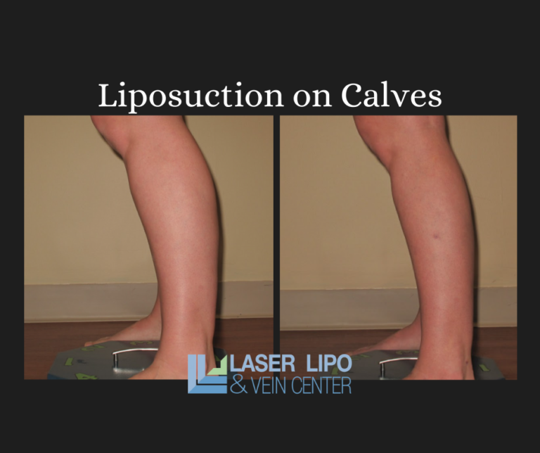 Lipo + Renuvion A Match Made in Heaven Laser Lipo