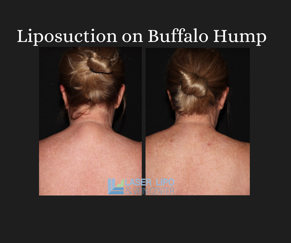 Liposuction On Buffalo Hump As An Effective Treatment Laser Lipo Veins