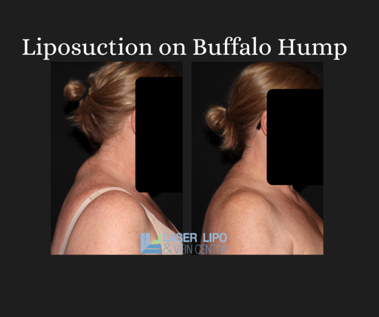 Liposuction on Buffalo Hump as an Effective Treatment Laser Lipo & Veins