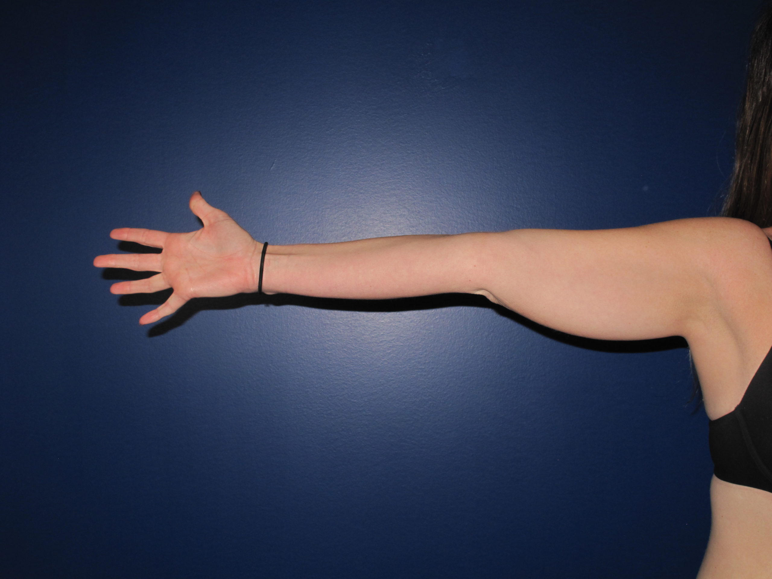 Liposuction Before and After Photos Laser Lipo & Vein Center