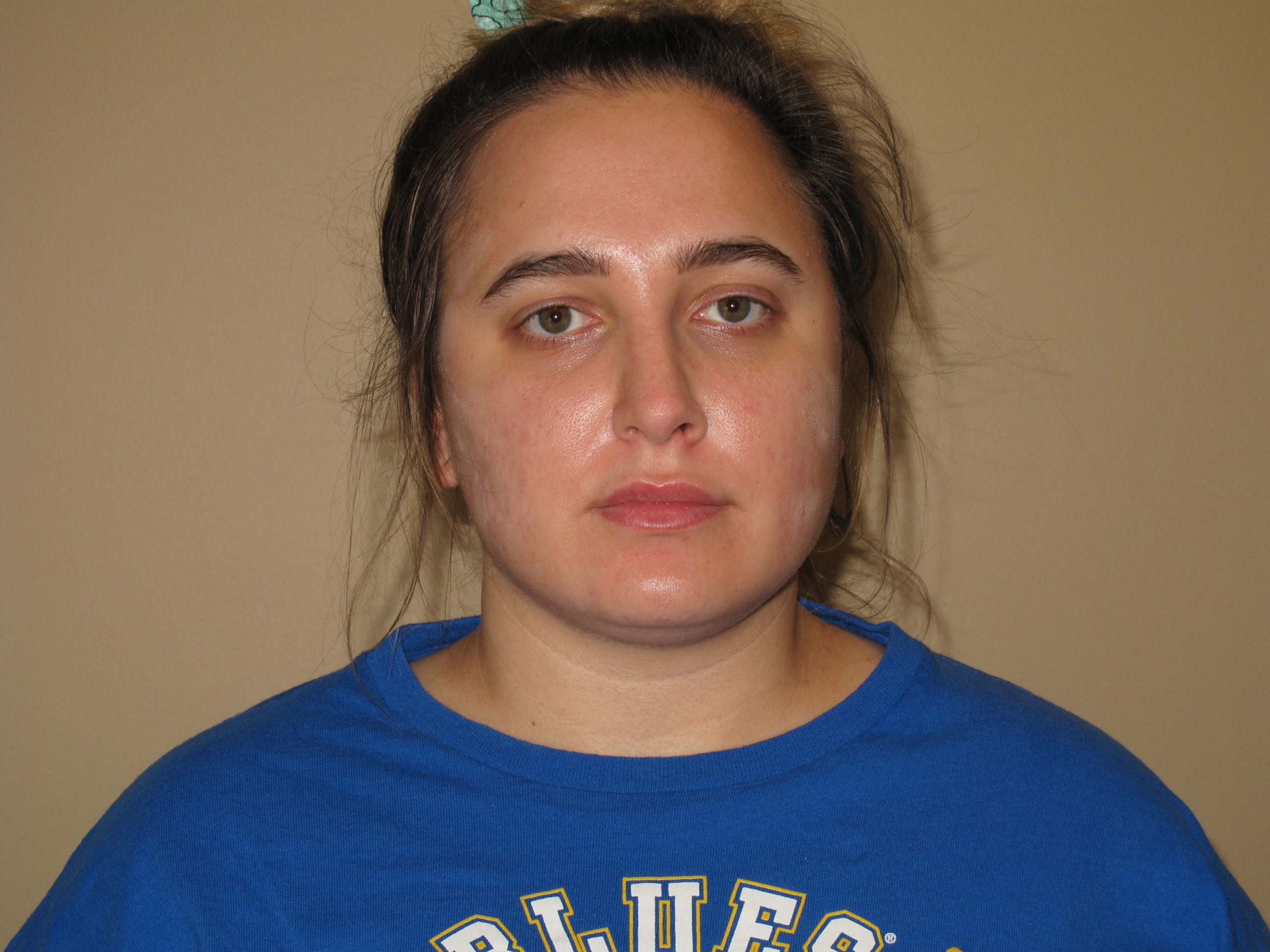 Liposuction Before and After Photos Laser Lipo & Vein Center