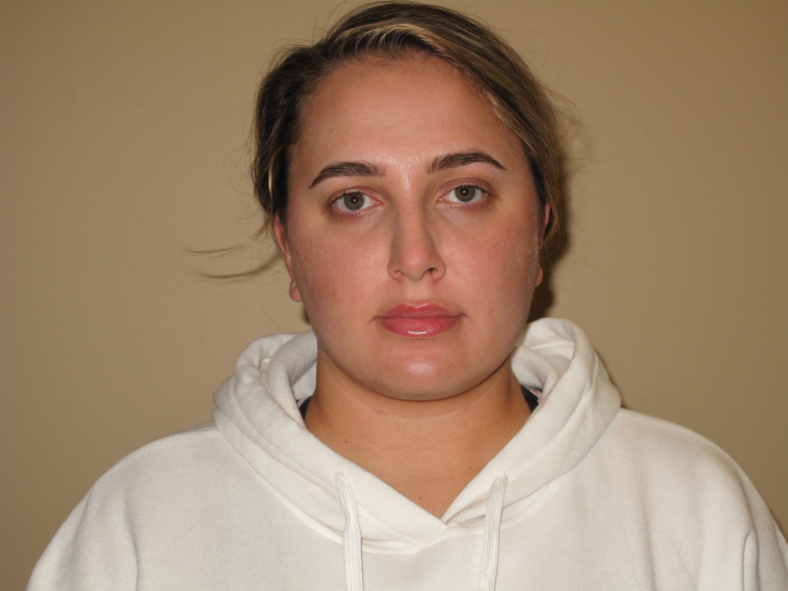 Liposuction Before and After Photos Laser Lipo & Vein Center