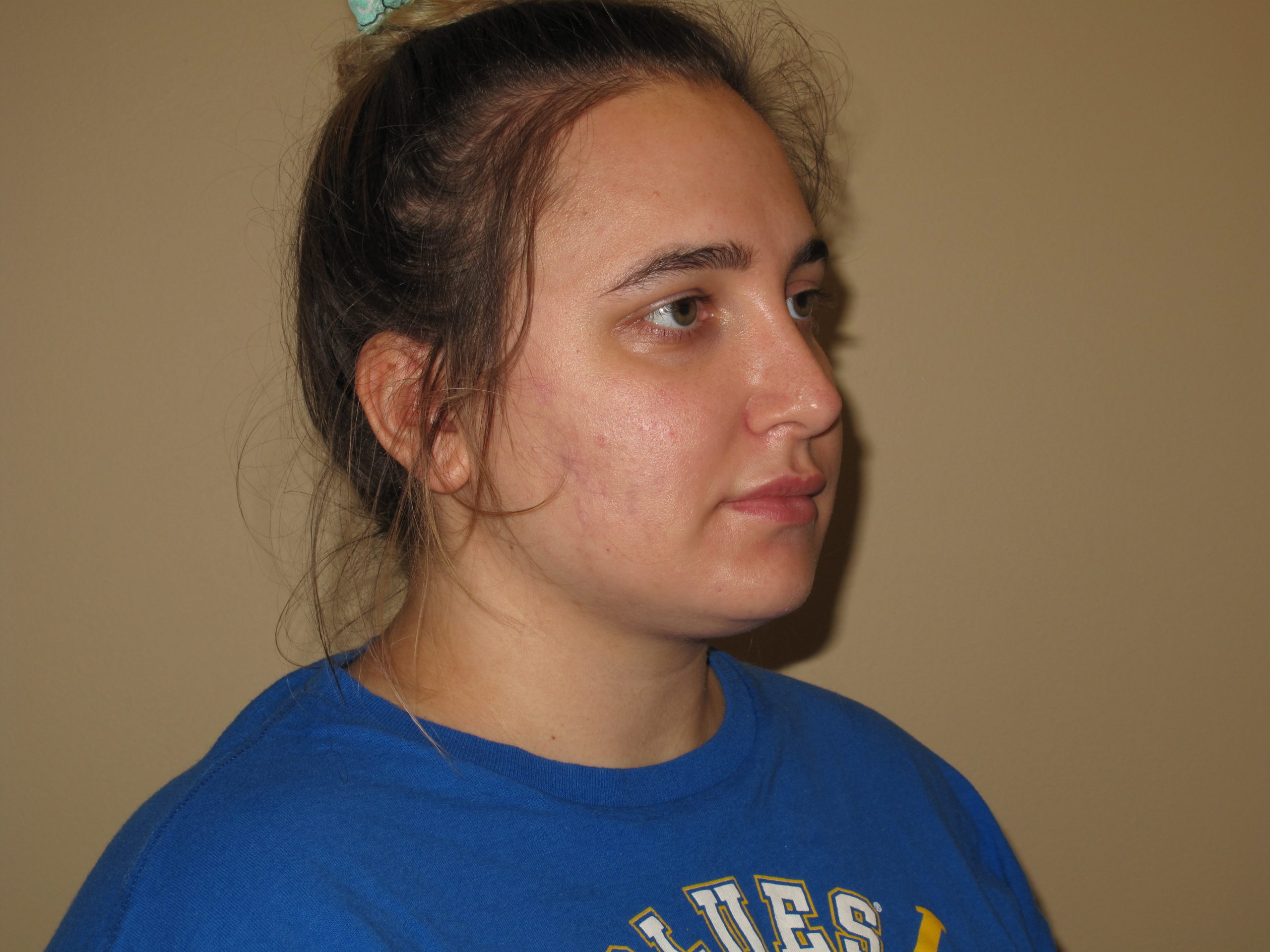 Liposuction Before and After Photos Laser Lipo & Vein Center