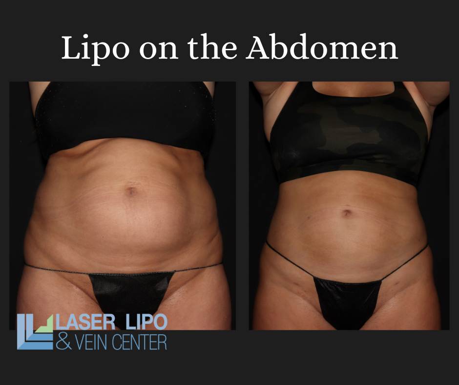 Achieving a Slimmer Figure with Lipo Slimming Injections