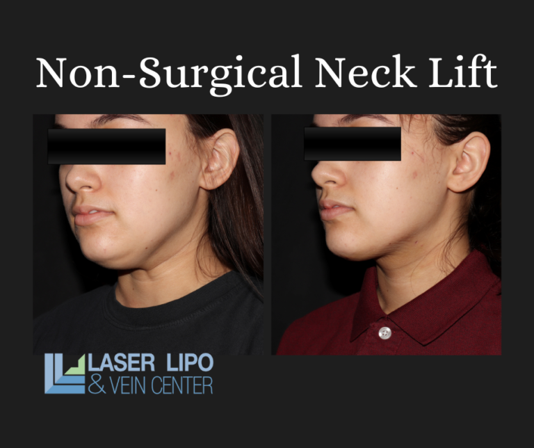 Check Out an Unbelievable Neck Lift Transformation Laser Lipo and Vein Center