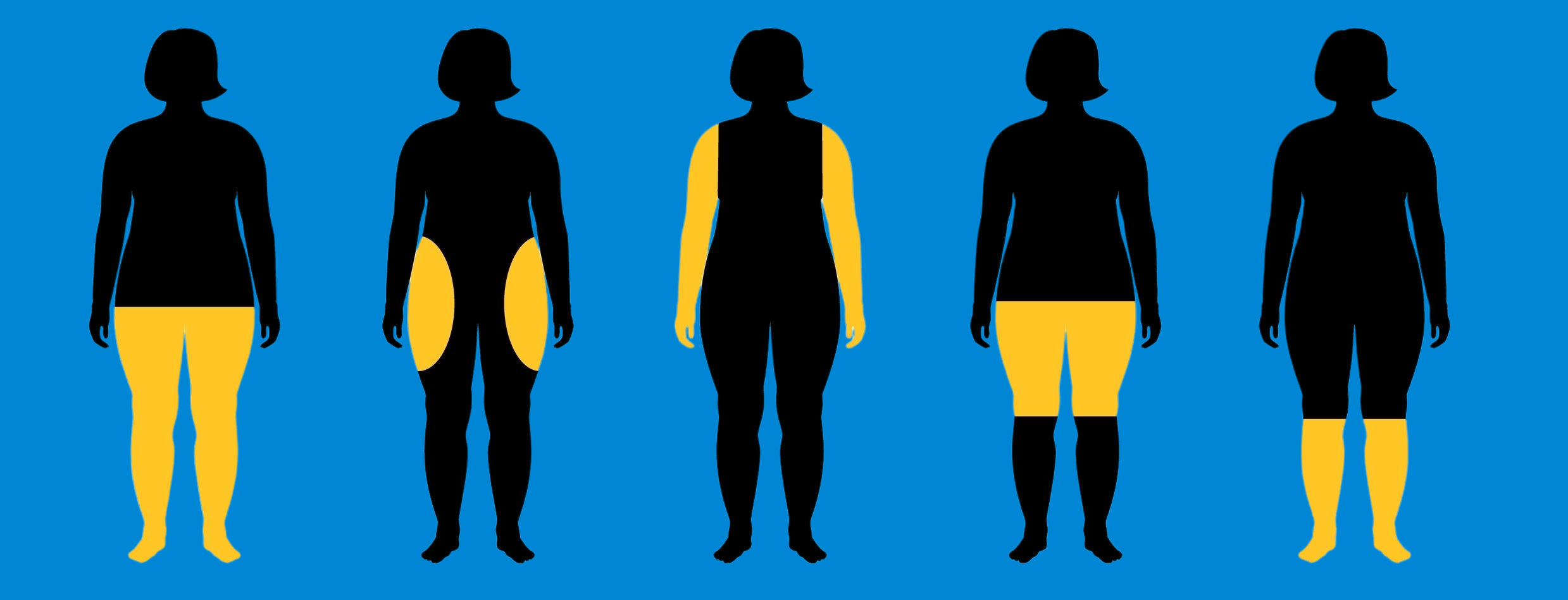 St Louis Lipedema Liposuction Treatment Laser Lipo and Vein Center