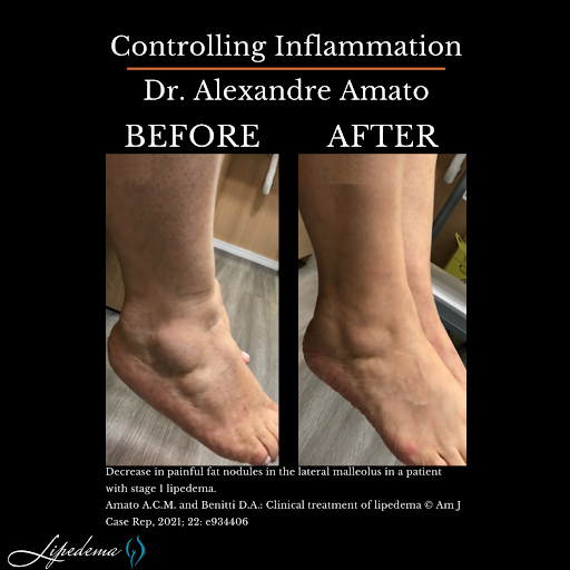 Lipedema Awareness Month and Tips for Managing Symptoms LLAV