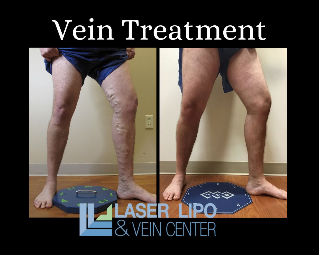 How to Treat Varicose Veins Without Surgery?