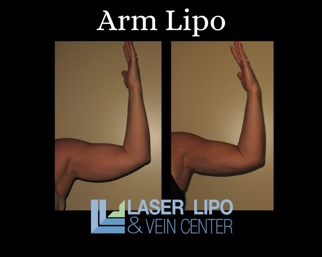 Arm Liposuction St. Louis Laser Lipo and Vein Center