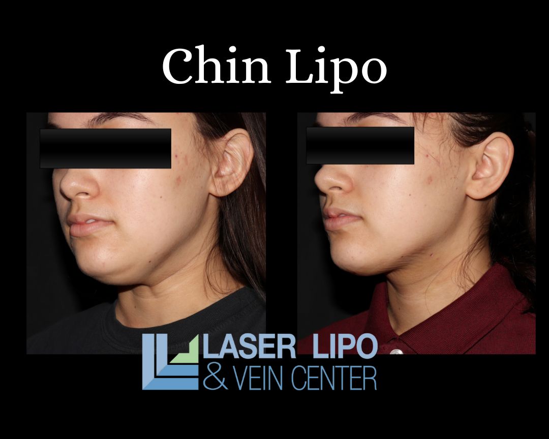 St Louis Cheek, Jowl, and Jawline Liposuction Laser Lipo and Vein Center