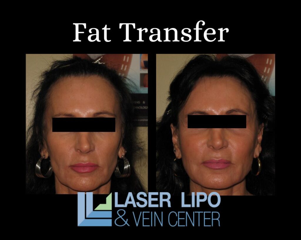 Fat Transfer St Louis Procedures St Louis Laser Lipo and Veins